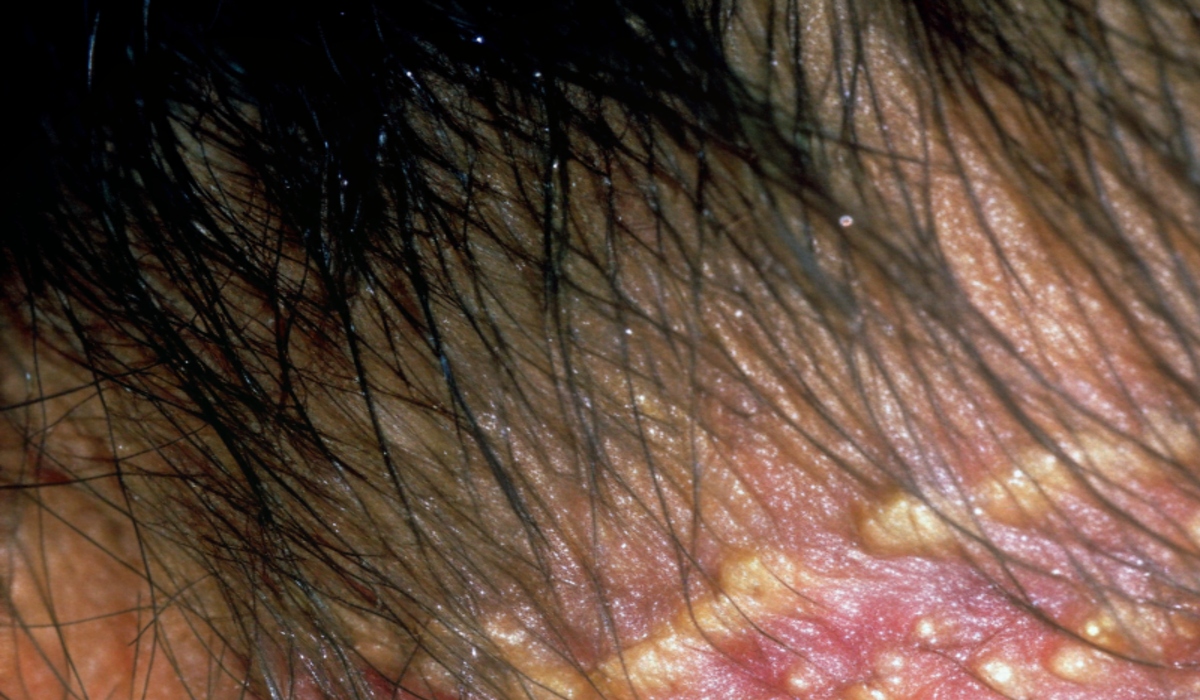 seasonal-dandruff-winter-care